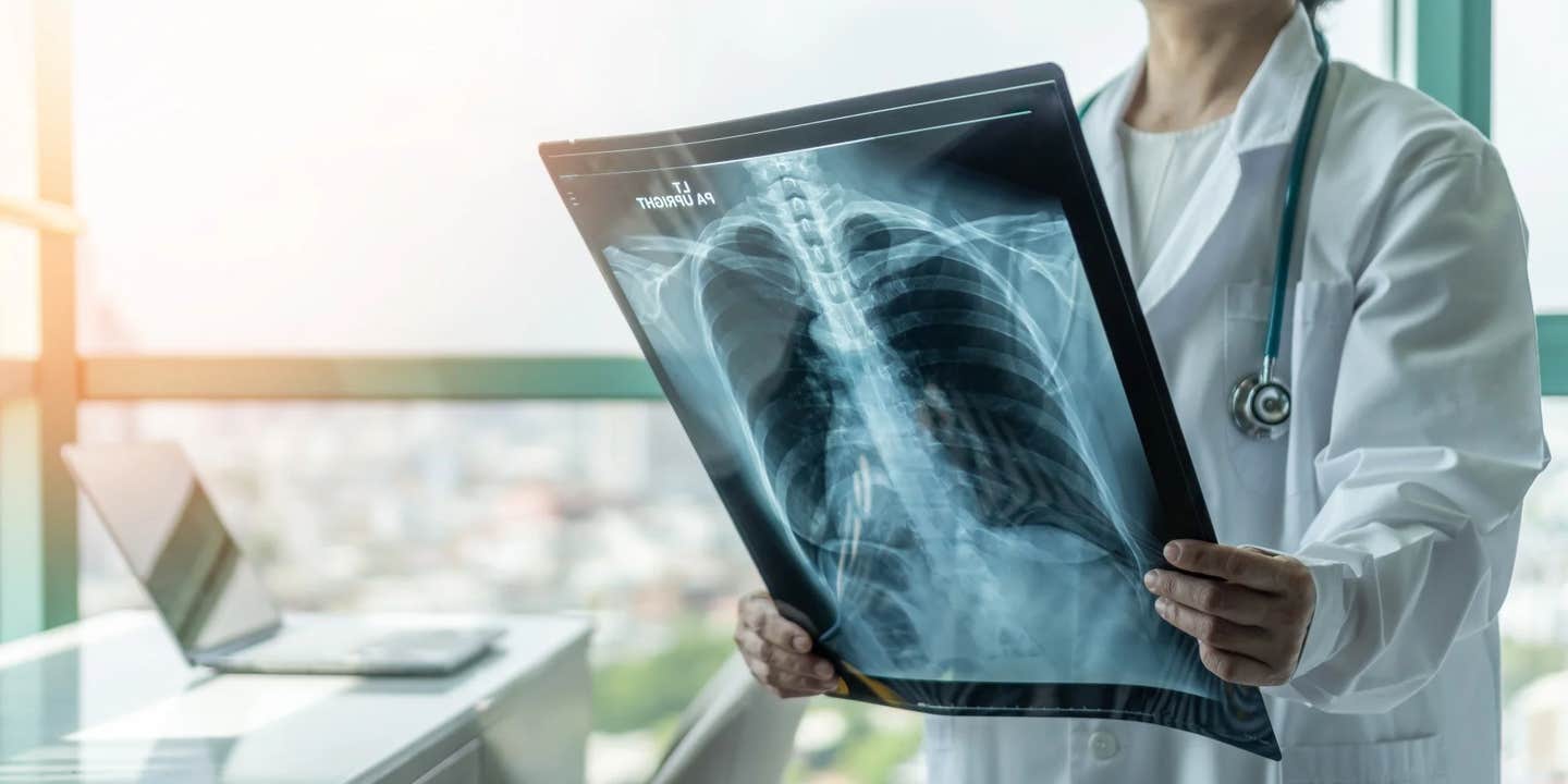 A major study from the University of Virginia finds that specific immune changes in Long COVID patients reveal the severity of their lung damage—offering new hope for targeted treatments.