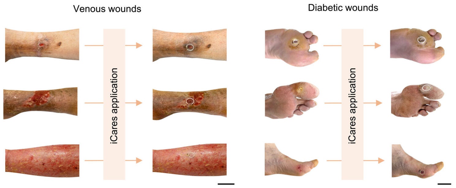 Representative images of venous wounds and diabetic wounds before and after iCares applications.