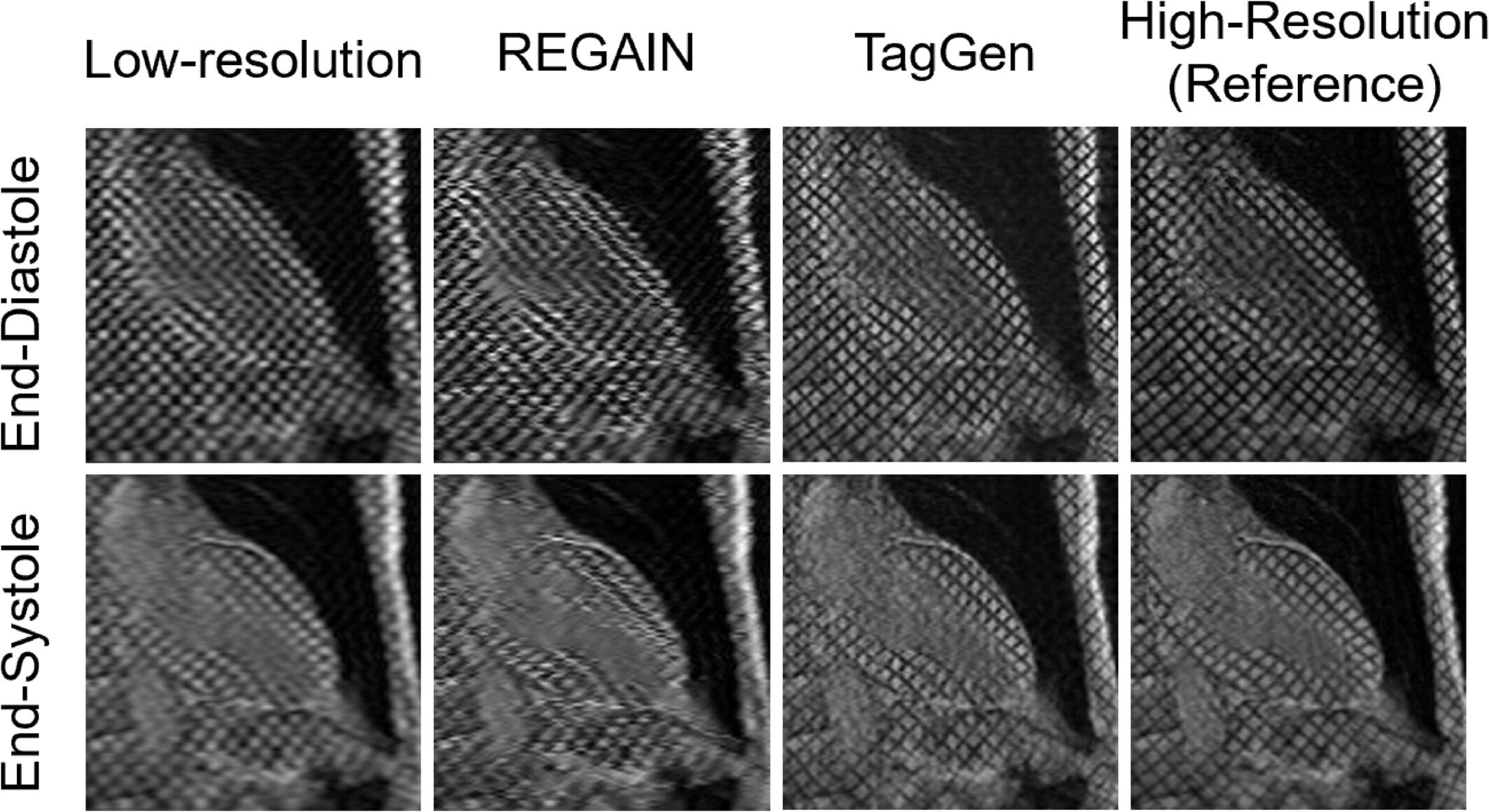 Comparisons of REGAIN and TagGen for super resolution of synthetic low-resolution MR tagging images for a patient with a rate-3.3 acceleration of the two-chamber view at end-diastole and end-systole.