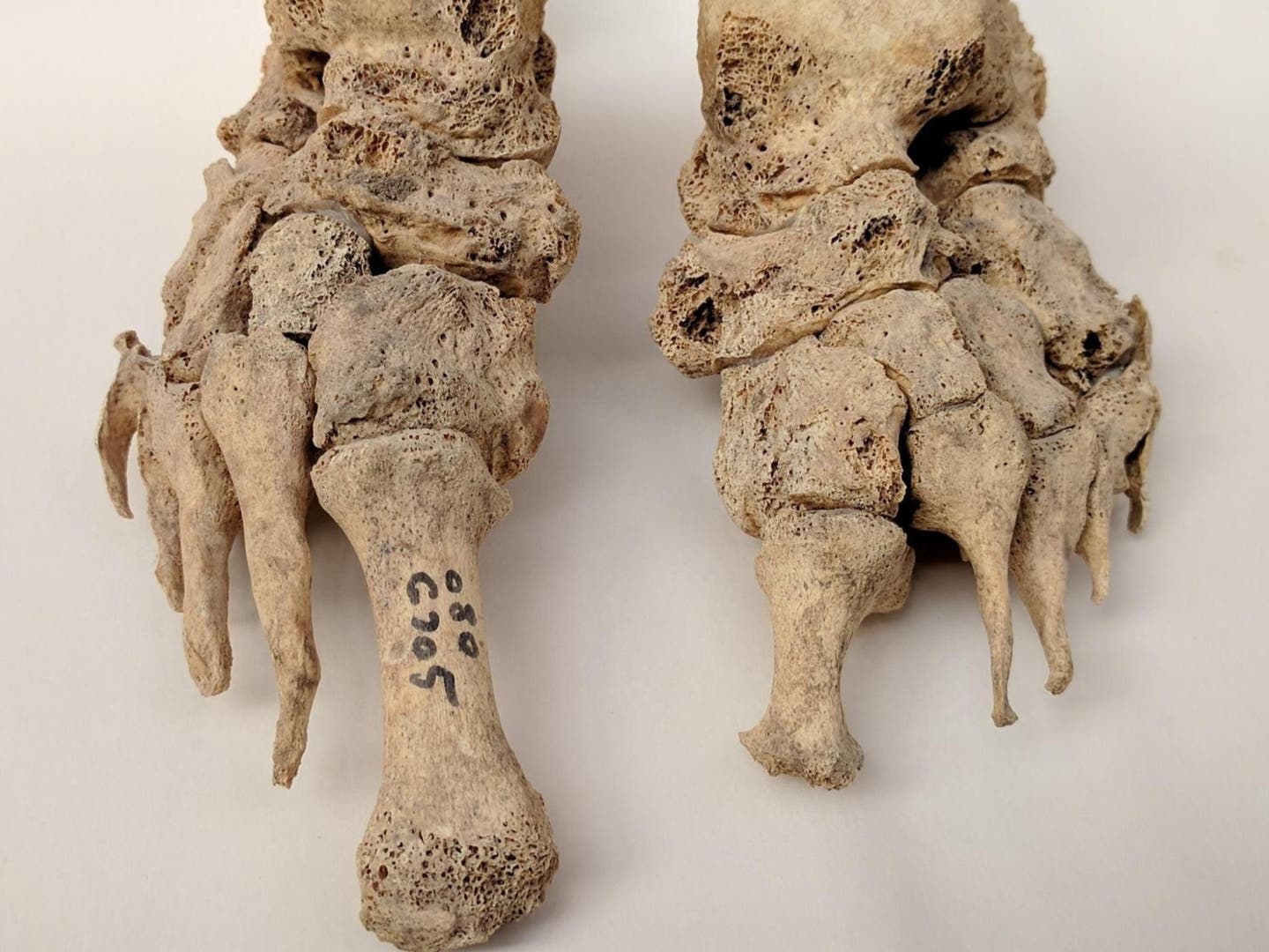 Leprosy of feet.
