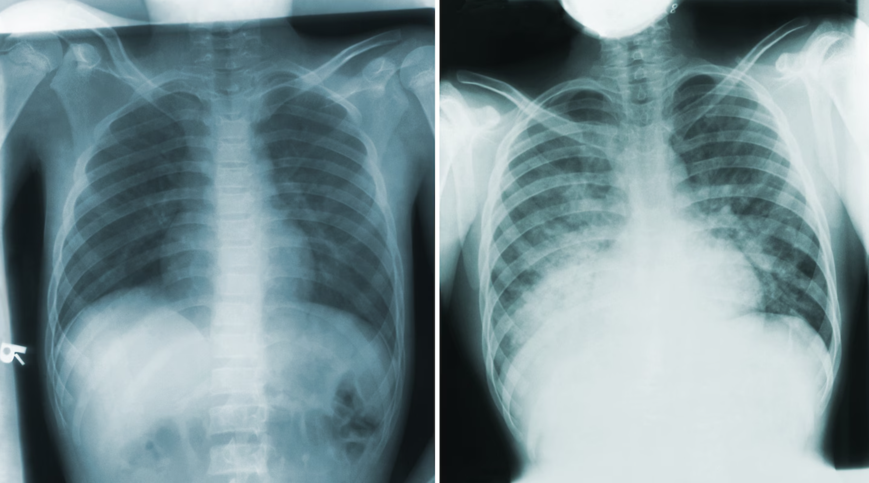 Contrasting lung x-rays showing a patient with normal airways juxtaposed against the same patient with Pneumonic Plague days later. 