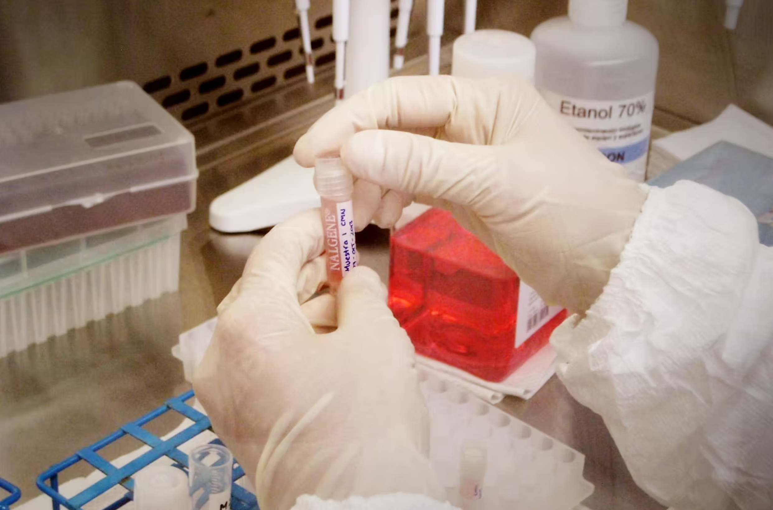 Blood levels of neurofilament light chain—a marker of nerve damage seen in multiple sclerosis—rose only after Epstein-Barr virus infection.