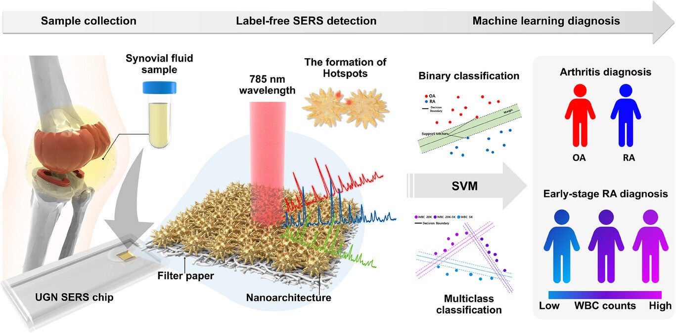 Schematic illustration of AI-assisted plasmonic sensing platform for OA and RA diagnosis.