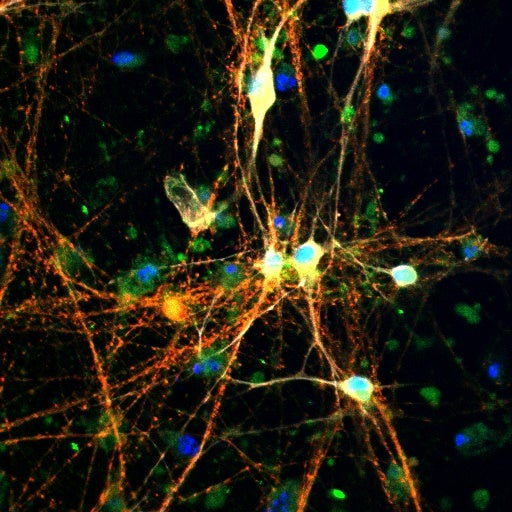 The image shows brain cells (neurons) where two substances are highlighted: tau, appears in red, and glycogen appears in green. Where the two overlap, the color turns yellow or orange, showing they are located close together.