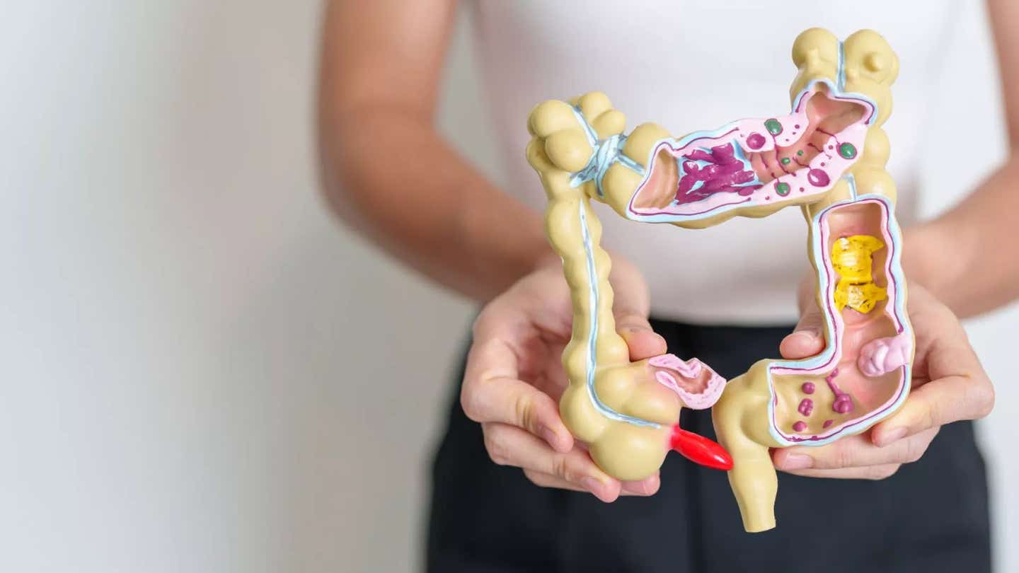 A new test developed at the University of Chicago detects early colon cancer by analyzing RNA modifications, achieving 95% accuracy.
