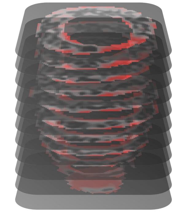 A contrast-enhanced cardiac MRI of a patient with hypertrophic cardiomyopathy deemed by MAARS to be at high risk for sudden death