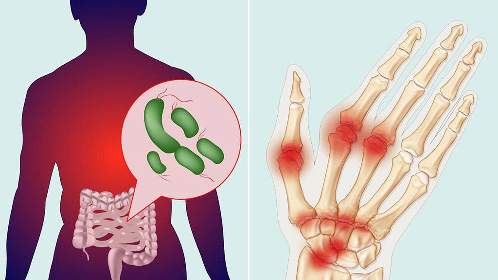 Because what you eat shapes your gut bacteria, changing your diet could help lower inflammation linked to arthritis.