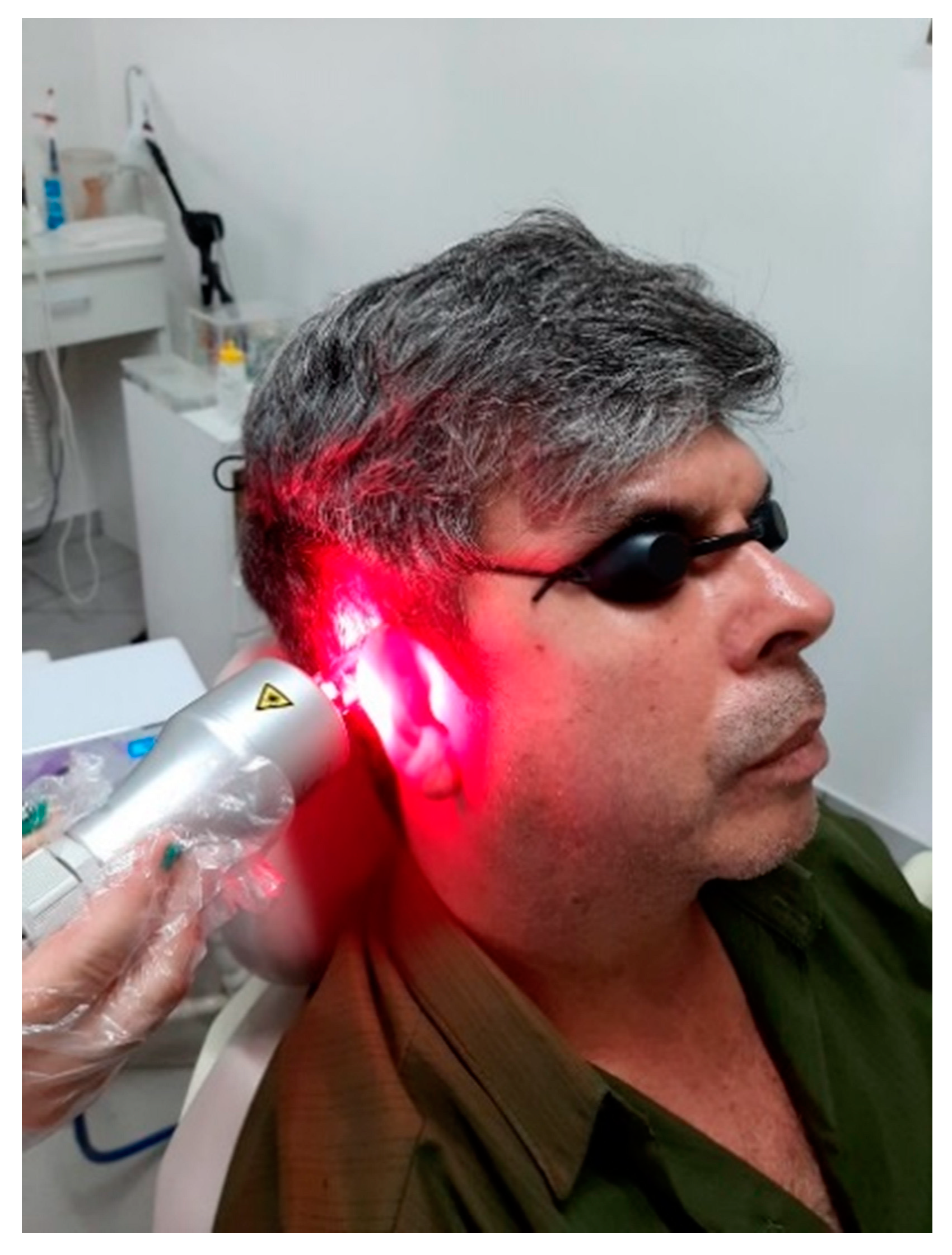 Device with suction cup and negative pressure combined with a cluster containing six LLLT outlets, three in red and three in infrared (VACUUMLASER, MMOPTICS, São Carlos–SP).