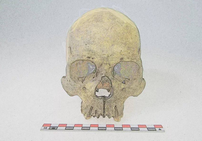 New DNA evidence reveals ancient leprosy in Chile, reshaping what scientists know about Hansen’s disease in the Americas.