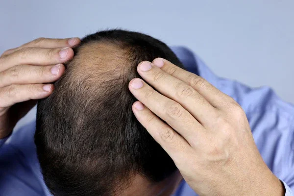 A breakthrough in treating male pattern baldness—which impacts nearly half of all men globally—may come from a natural sugar found in the body.