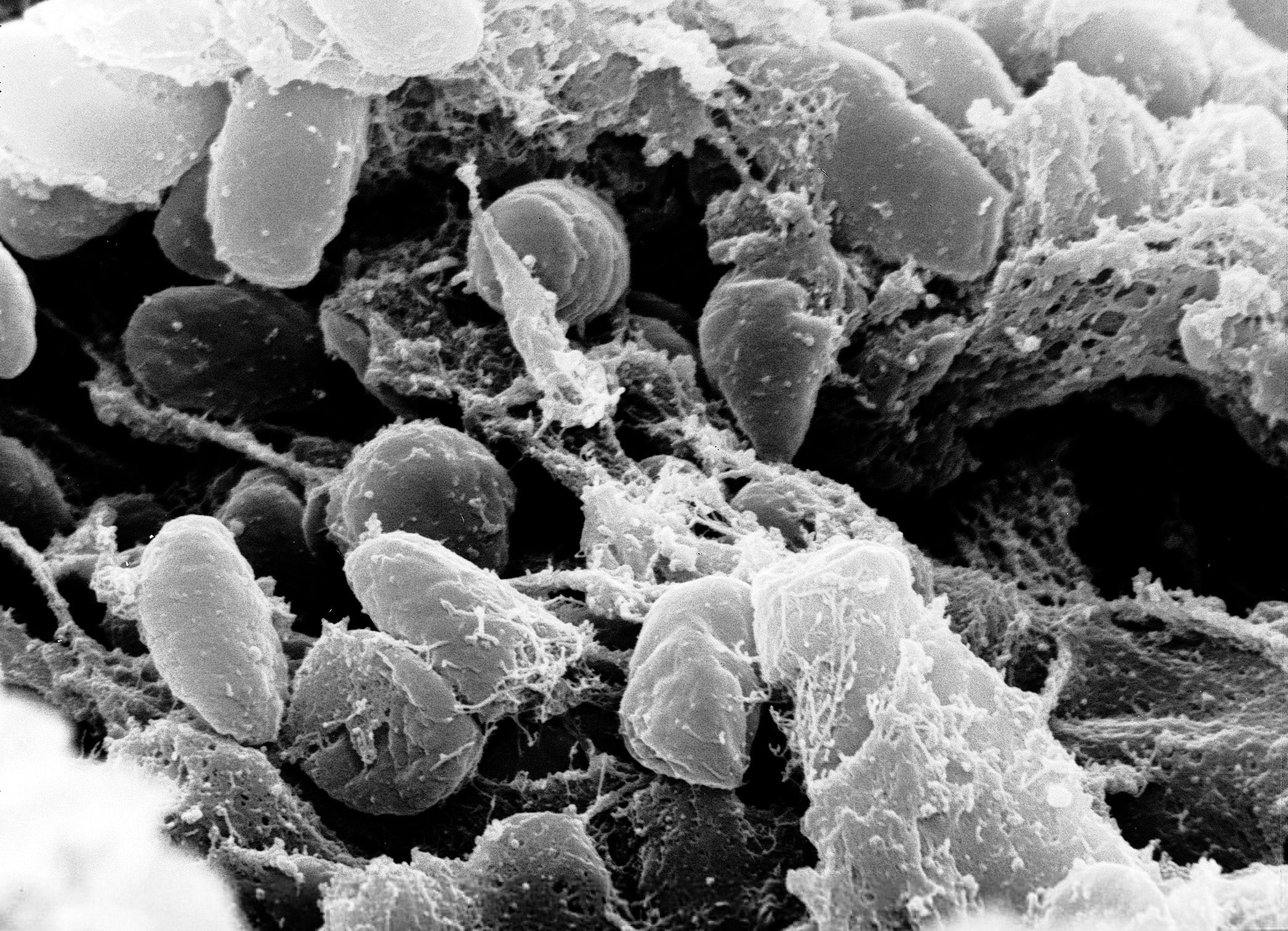 Pneumonic plague develops when the bacterium Yersinia pestis infects a person's lungs.