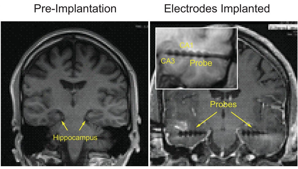 3T MRI showing pre-implantation hippocampal structures and post-implantation electrode locations in one subject. The bulges visible in the probe are the location of the “macro” electrode sites.