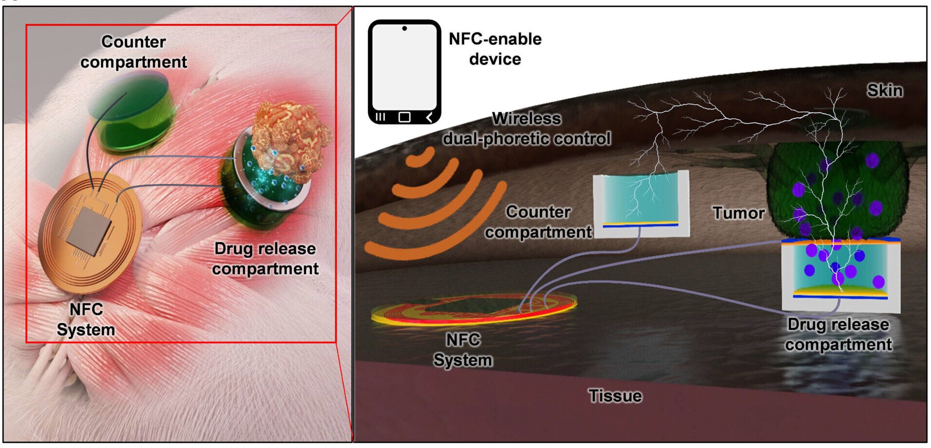 Wireless dual-phoretic device with the capability of electrophoretic and iontophoretic drug delivery.