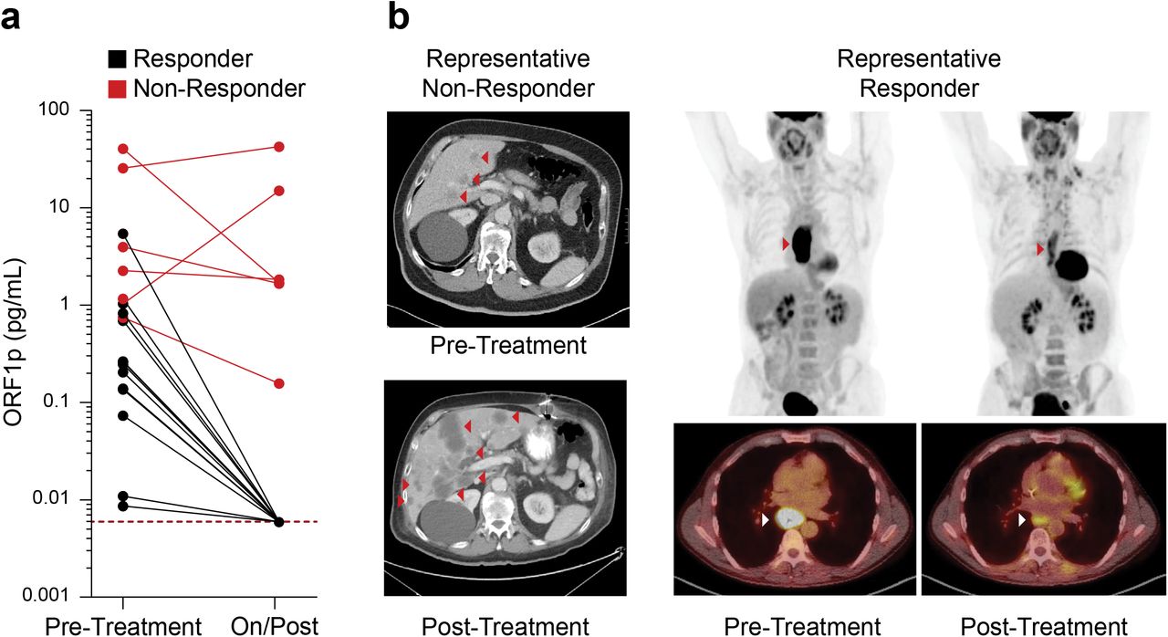 ORF1p is an early predictor of response in 19 gastroesophageal patients undergoing chemo/chemoradiotherapy.