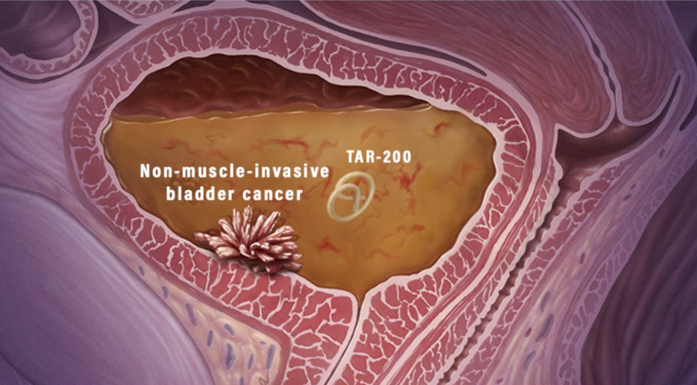 TAR-200 implanted into the bladder. 