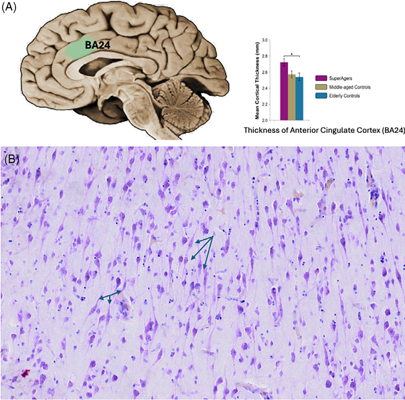 (A) The green area in the rendering of the brain on the left depicts the anterior cingulate cortex, which in quantitative magnetic resonance imaging studies was found to be thicker in SuperAgers not only compared to age-matched neurotypical controls but also compared to a cohort of normal individuals 20 to 30 years younger. (B) Micrograph of Nissl-stained neurons in the anterior cingulate cortex of a SuperAger brain, visualizing a population of von Economo neurons (arrows). Von Economo neurons are found in considerably higher density in SuperAgers. 