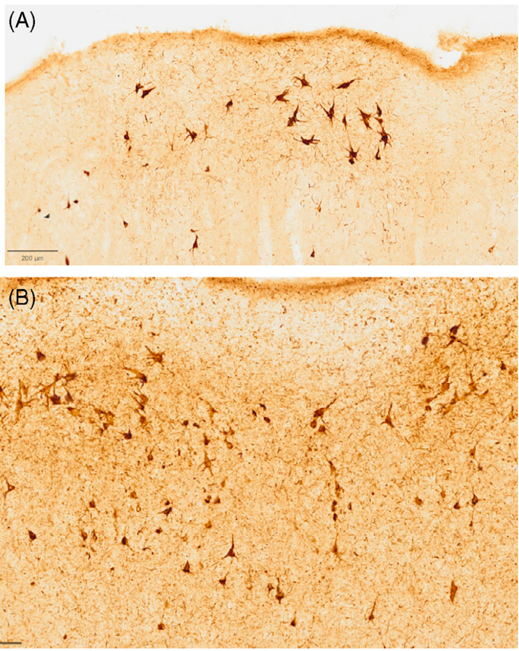 (A) Superagers display significantly lower density ofneurofibrillary tangles and pre-tangles in the entorhinal cortexcompared to neurotypical elderly (B).