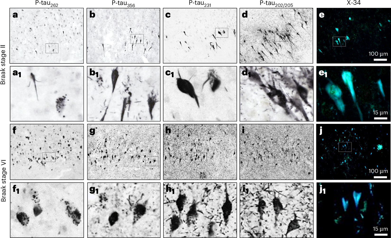 Chromogen immunohistochemistry (IHC) analyses of tau forms with phosphorylated epitopes inside (p-tau262, p-tau356) and outside (p-tau231, p-tau202/205 (AT8)) the STA core region in postmortem human hippocampus.