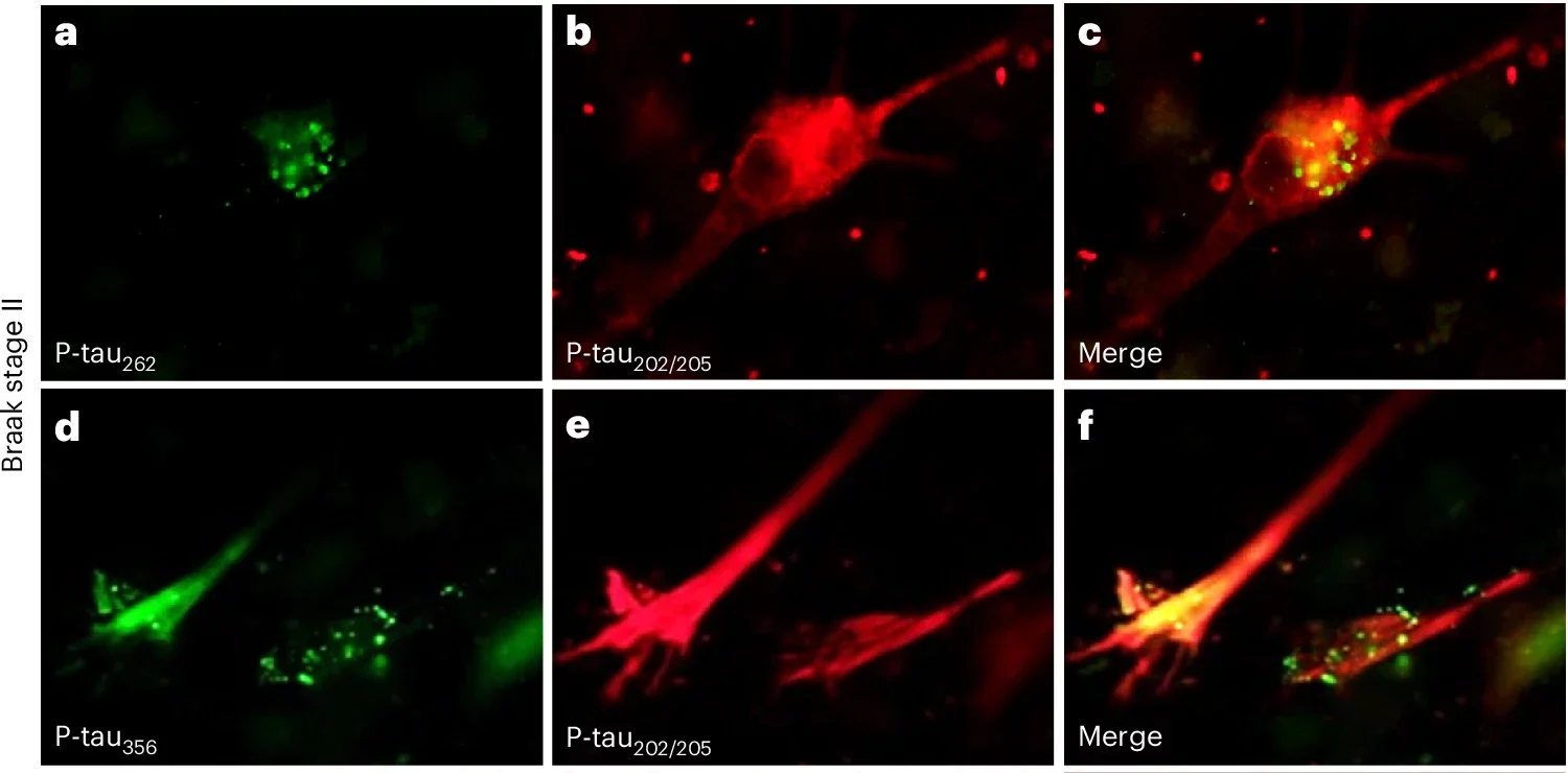 Dual immunofluorescence staining of the p-tau262 and p-tau356 sites in the STA core versus p-tau202/205 (AT8) in the fuzzy coat in human postmortem tissue at early and late Braak NFT stages. 