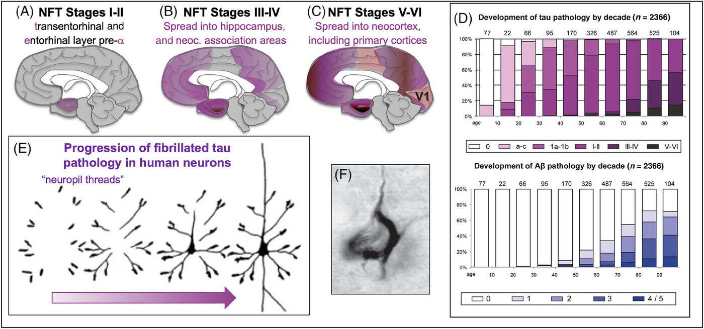 Progression of fibrillated tau pathology in primate brain and comparison to amyloid.