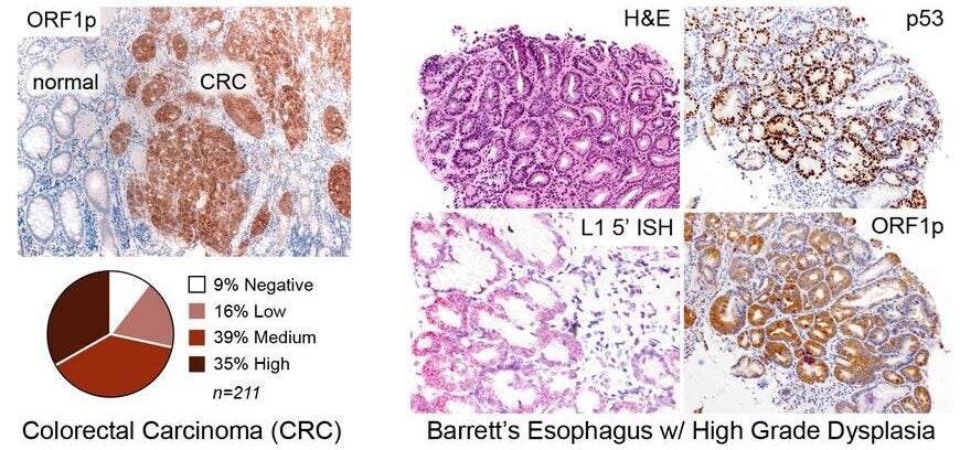 ORF1p expression is early and pervasive in carcinomas. ORF1p immunostaining in a cohort of 211 colorectal cancers. 