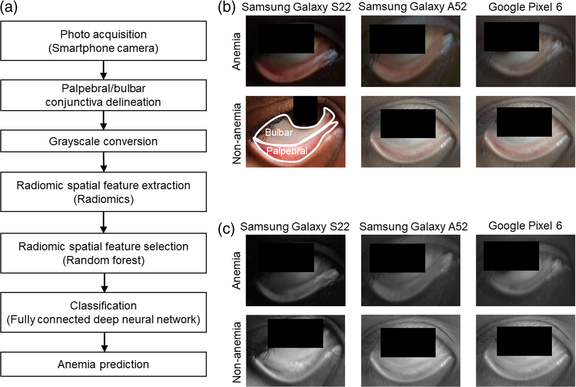 mHealth radiomic analyses of grayscale conjunctiva photographs for anemia prediction.