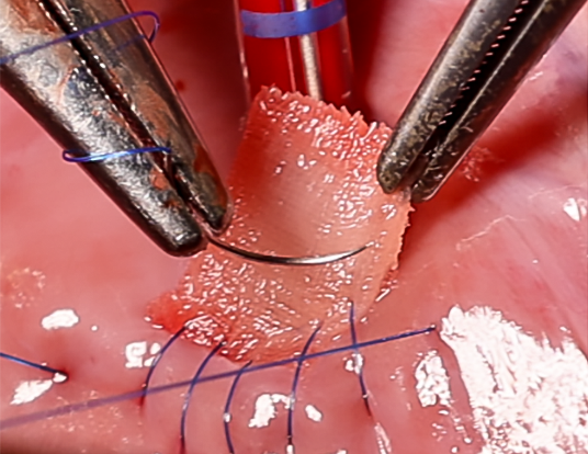 The support scaffold is implanted into the heart defect and covered with the mesh.