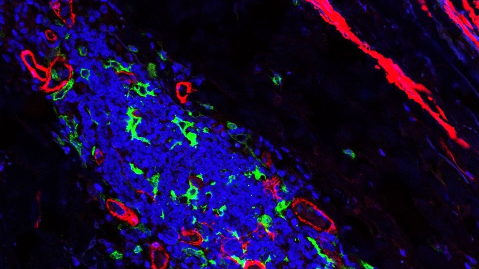 Immunofluorescent image of immune cells in tissues affected by autoimmune disease, giant cell arteritis.