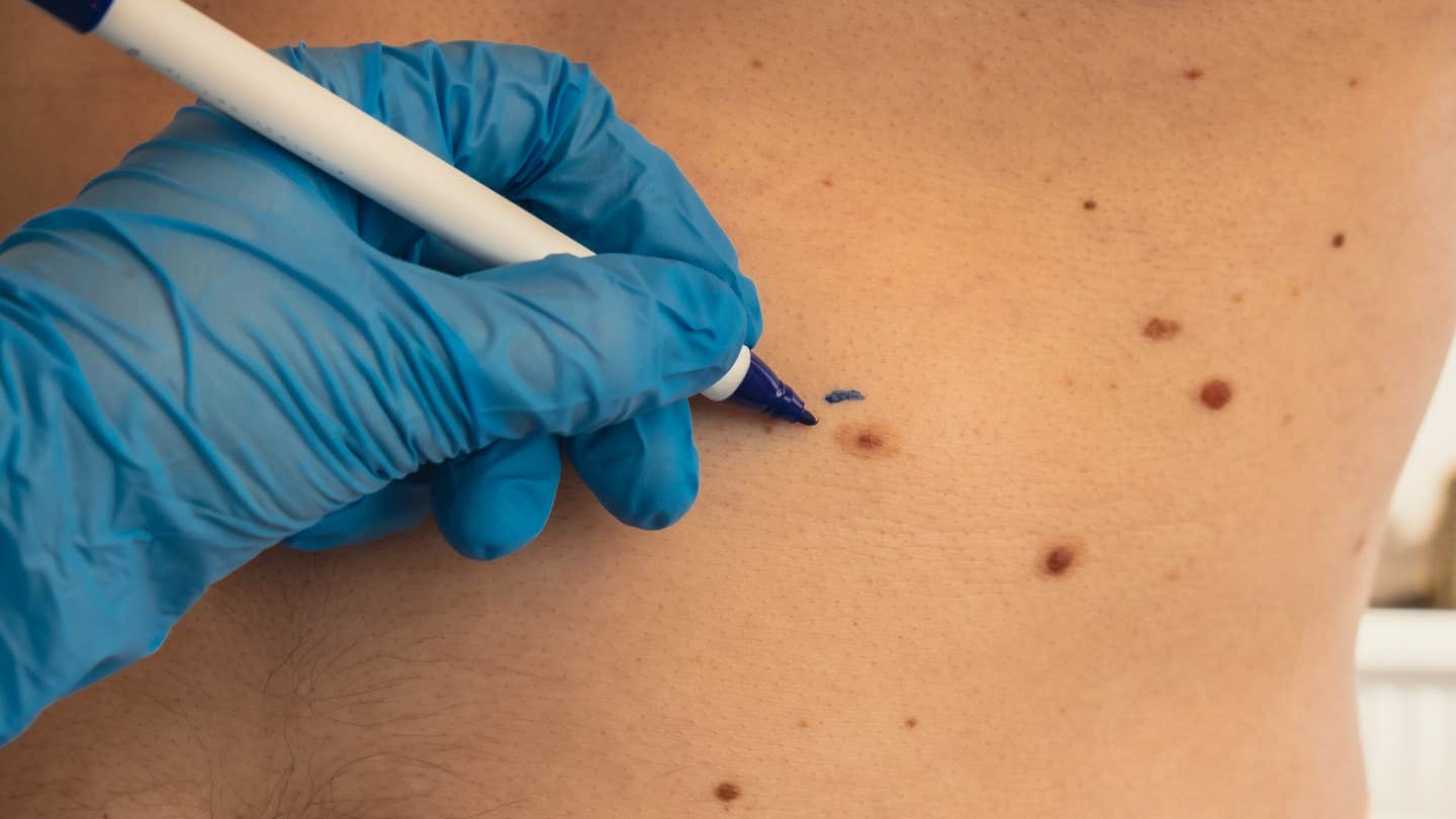 Researchers at Moffitt Cancer Center have discovered a triple immunotherapy that may shrink tumors in treatment-resistant melanoma. By blocking three key immune checkpoints—PD-1, LAG-3, and TIM-3—this approach revived the immune system and led to tumor regression in lab models. The findings could lead to new second-line treatments for patients who don’t respond to current therapies.