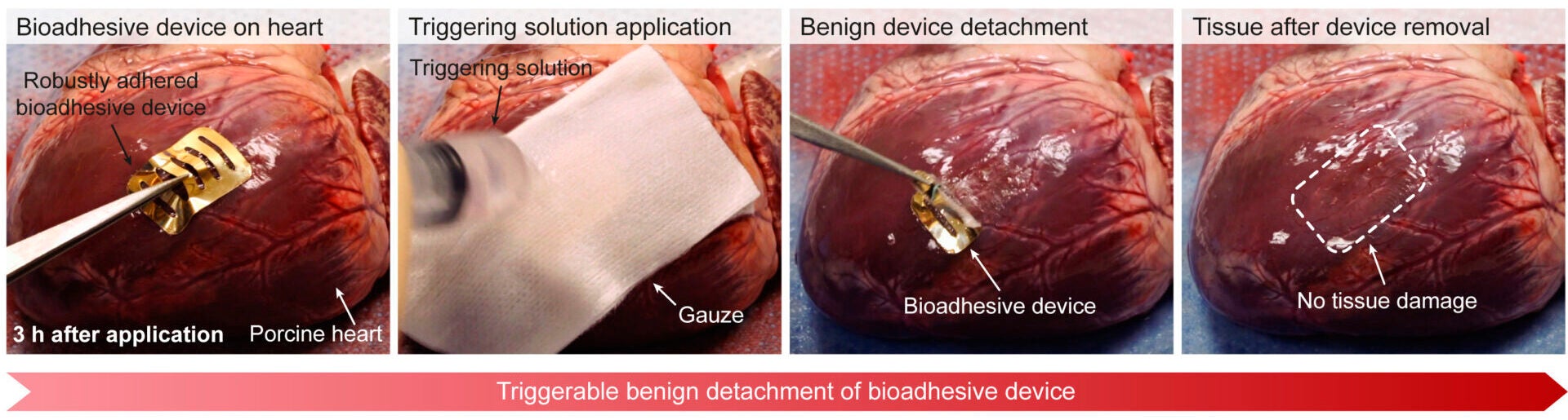 Schematic photographs for instant robust adhesion and on-demand removal of a bioadhesive device on a beating ex vivo porcine heart. TPU, thermoplastic polyurethane.