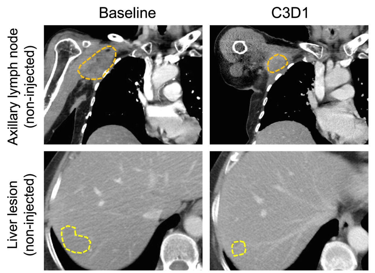 Radiographic assessment of non-target axillary lymph nodes and liver metastases from patient 14 at baseline and after treatment.