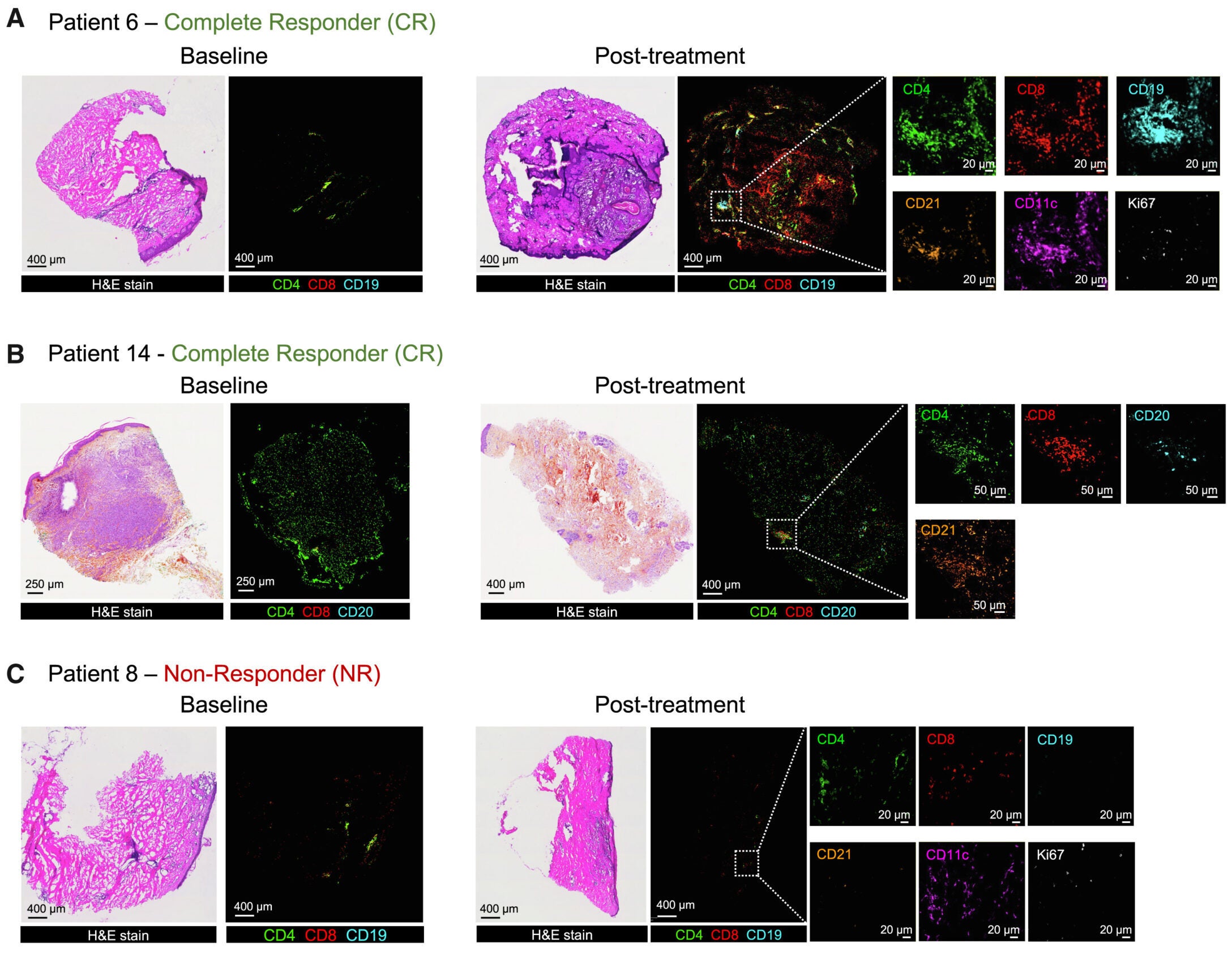 2141-V11 is associated with tertiary lymphoid structures and increased immune cell infiltration in post-treatment biopsies from responders. 