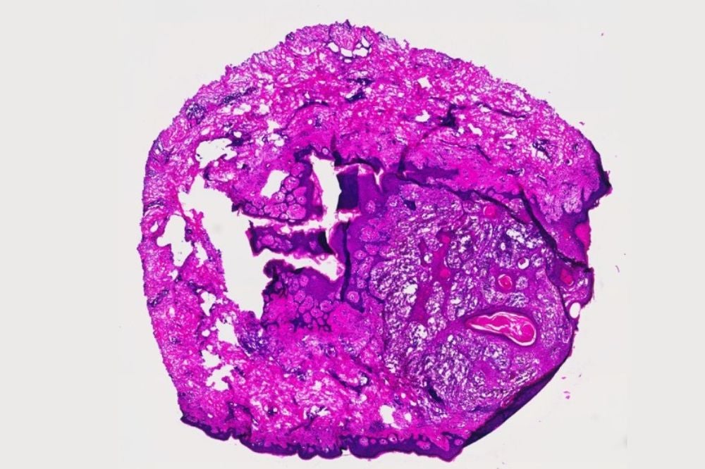 Histology image of a patient whose metastatic cancer went into complete remission after receiving a new immunotherapy treatment.