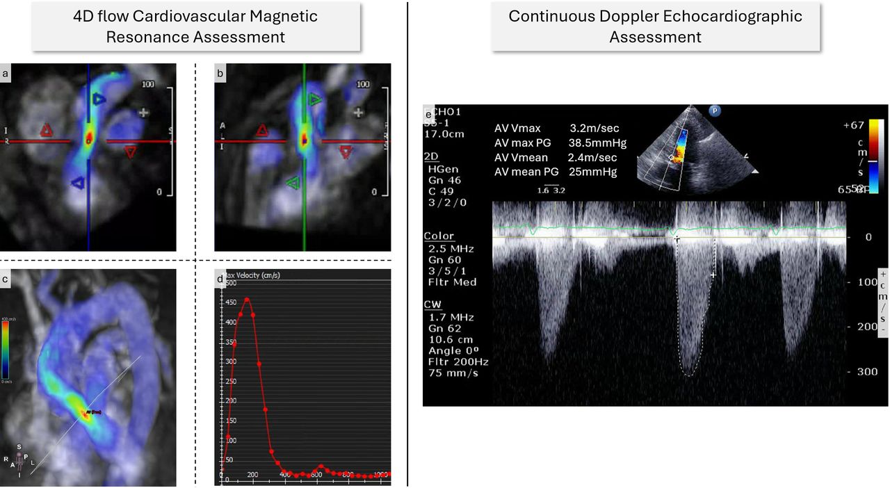 4D flow cardiovascular magnetic resonance assessment and continuous Doppler echocardiographic assessment.