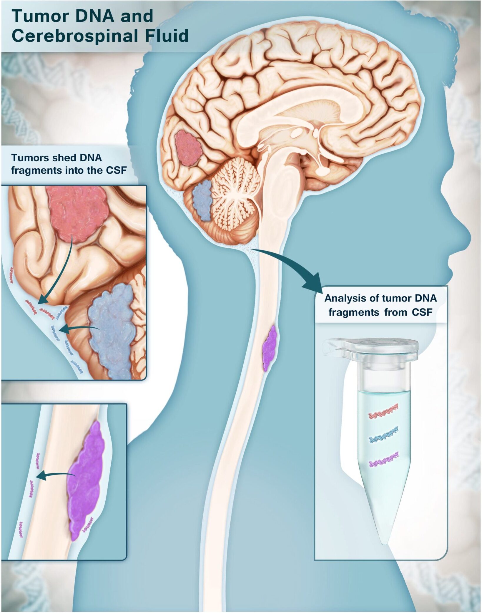 Multi-analyte test can accurately identify brain cancers using small samples of cerebrospinal fluid.