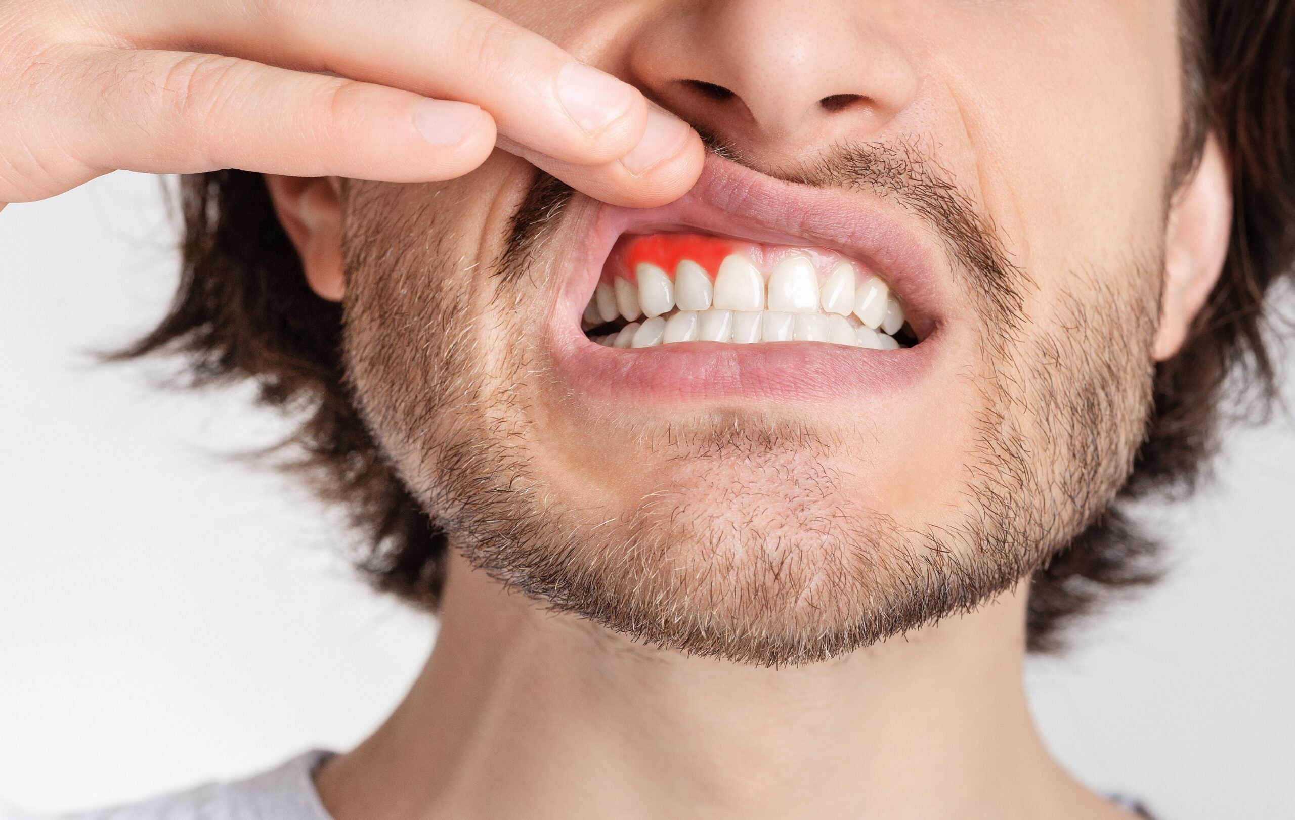 Gum disease, also called periodontal disease, happens when the tissues holding your teeth become irritated and infected.