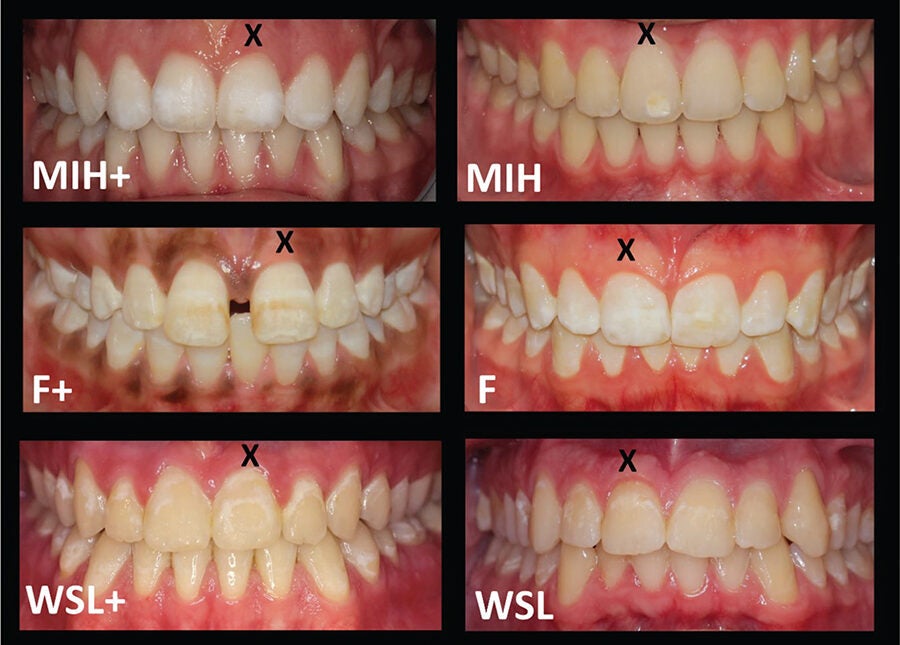 Some of the images that the participants were exposed to, with different color deviations on the teeth 