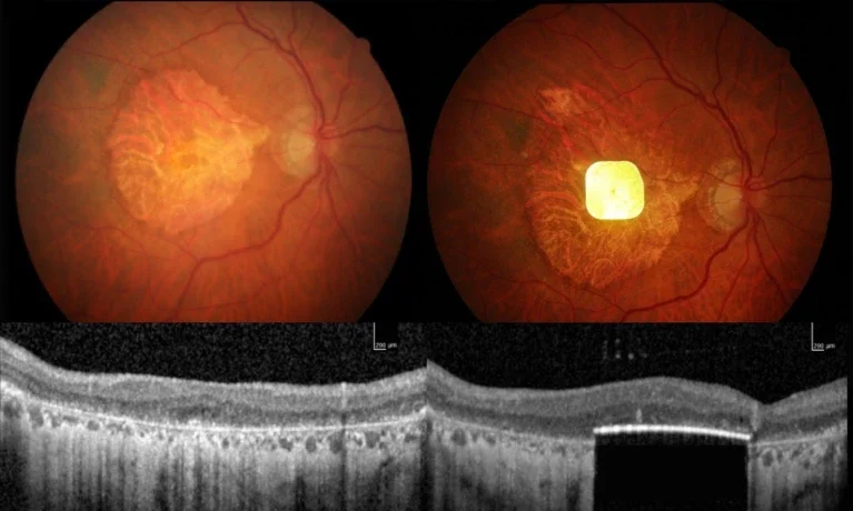 Image of the chip in a patient’s eye.