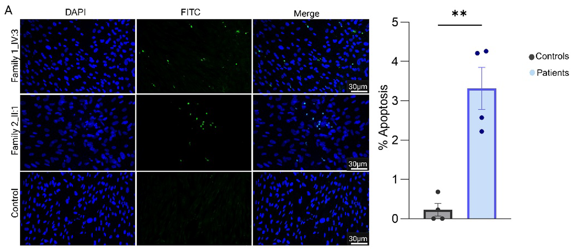 Representative images of TUNEL staining showing increased apoptosis in patient-derived fibroblasts compared to controls, with quantification of apoptotic cells (% apoptosis, right). 
