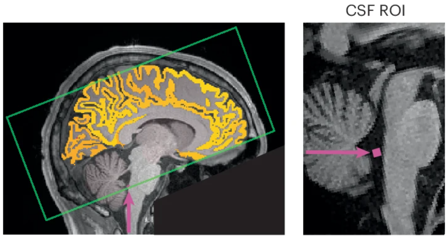 After sleep deprivation, CSF flow exhibits large sleep-like low-frequency waves during wakefulness.