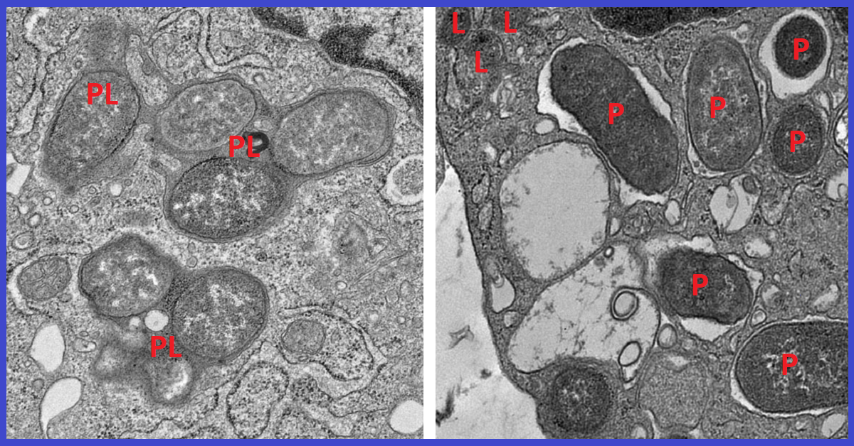 Electron micrographs show how macrophages expressing girdin neutralize pathogens by fusing phagosomes (P) with the cell’s lysosomes (L) to form phagolysosomes (PL), compartments where pathogens and cellular debris are broken down (left).
