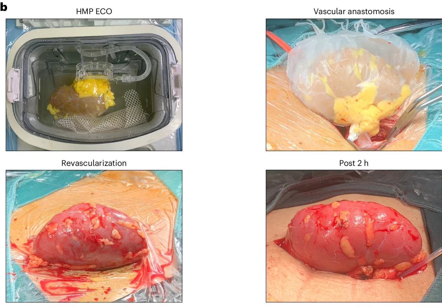 The ECO kidney was successfully transplanted into a type-O brain-dead recipient, avoiding hyperacute rejection.
