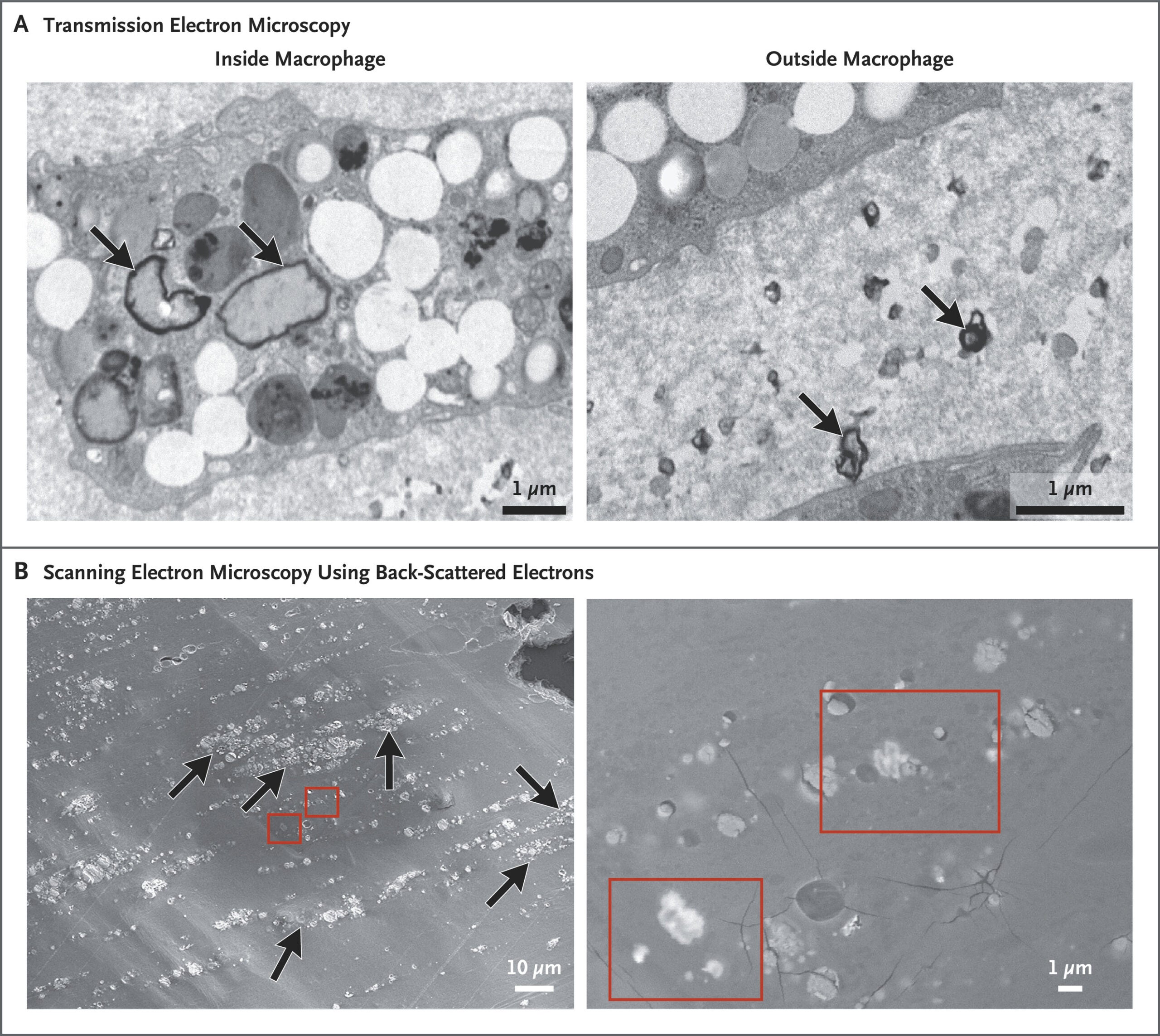 Electron microscopy analysis of atheromatous plaque. Transmission electron microscopy images of particles of high internal electron transparency contoured by a very thin electron opaque line.