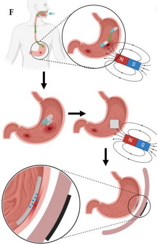 Working principle of the origami actuator for non-invasive drug delivery to treat stomach ulcers.