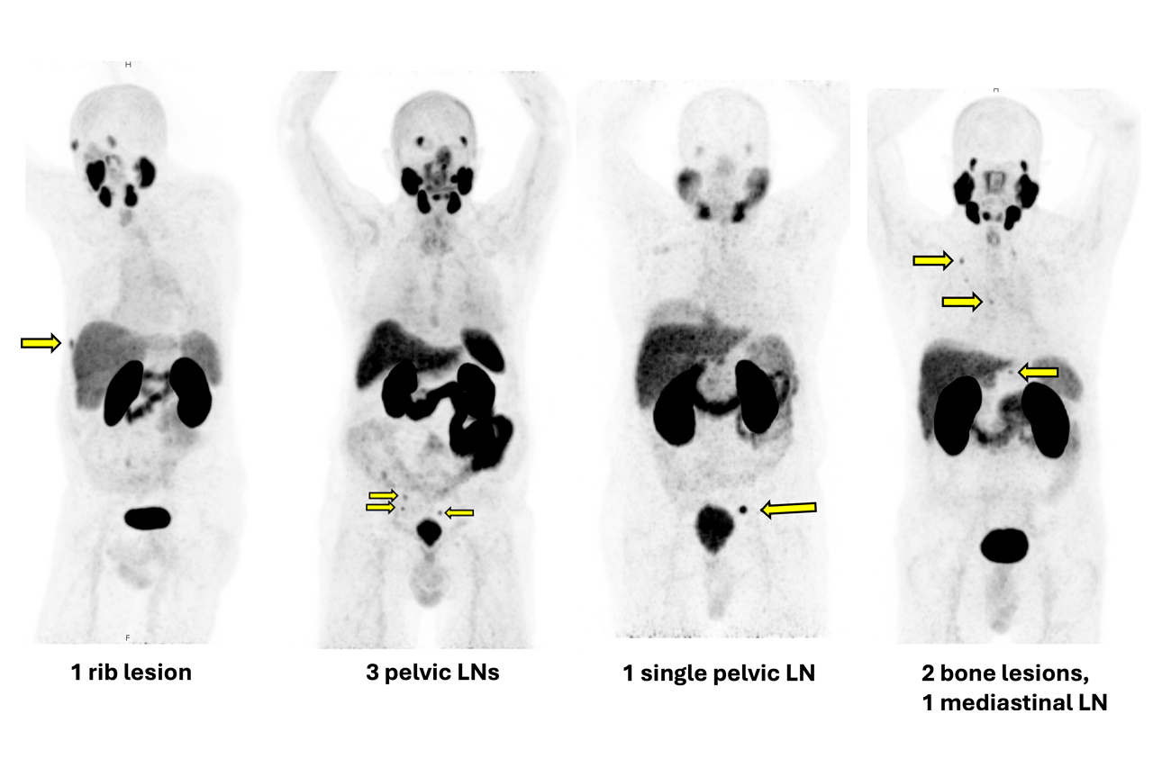 Figure of PSMA PET scans.