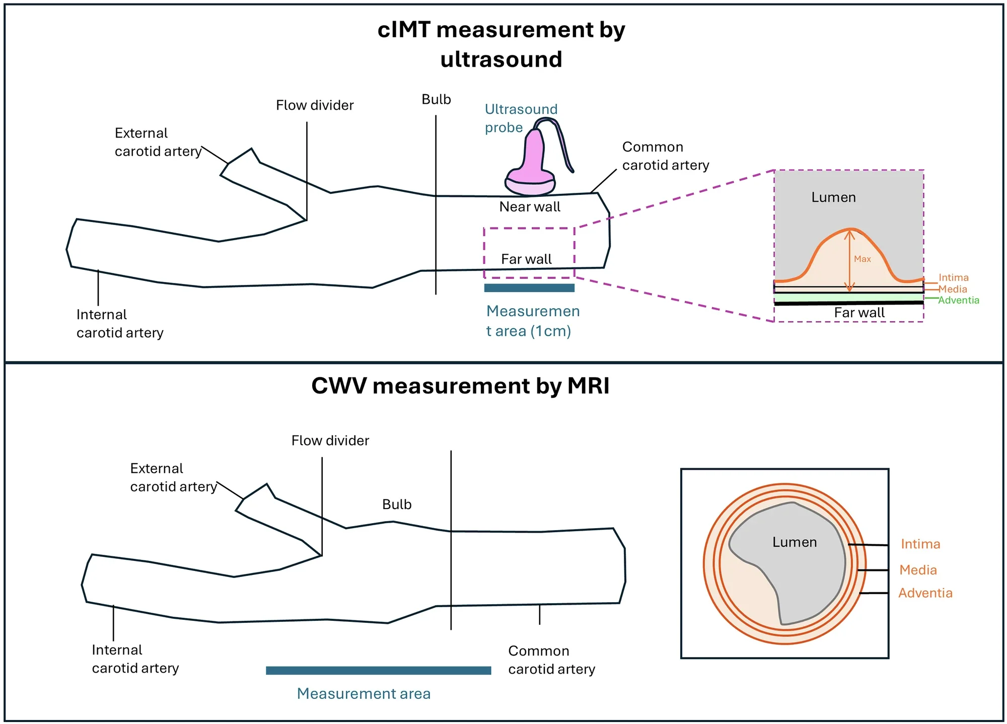 Schematic overview of carotid intima-media thickness (cIMT) measurement using ultrasound (top) and carotid wall volume (CWV) measurement using magnetic resonance imaging (MRI; bottom).