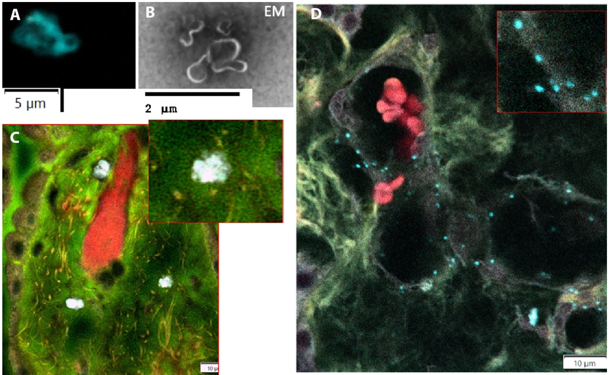 Confocal and EM of microplastics in brain of cognitively impaired adults.