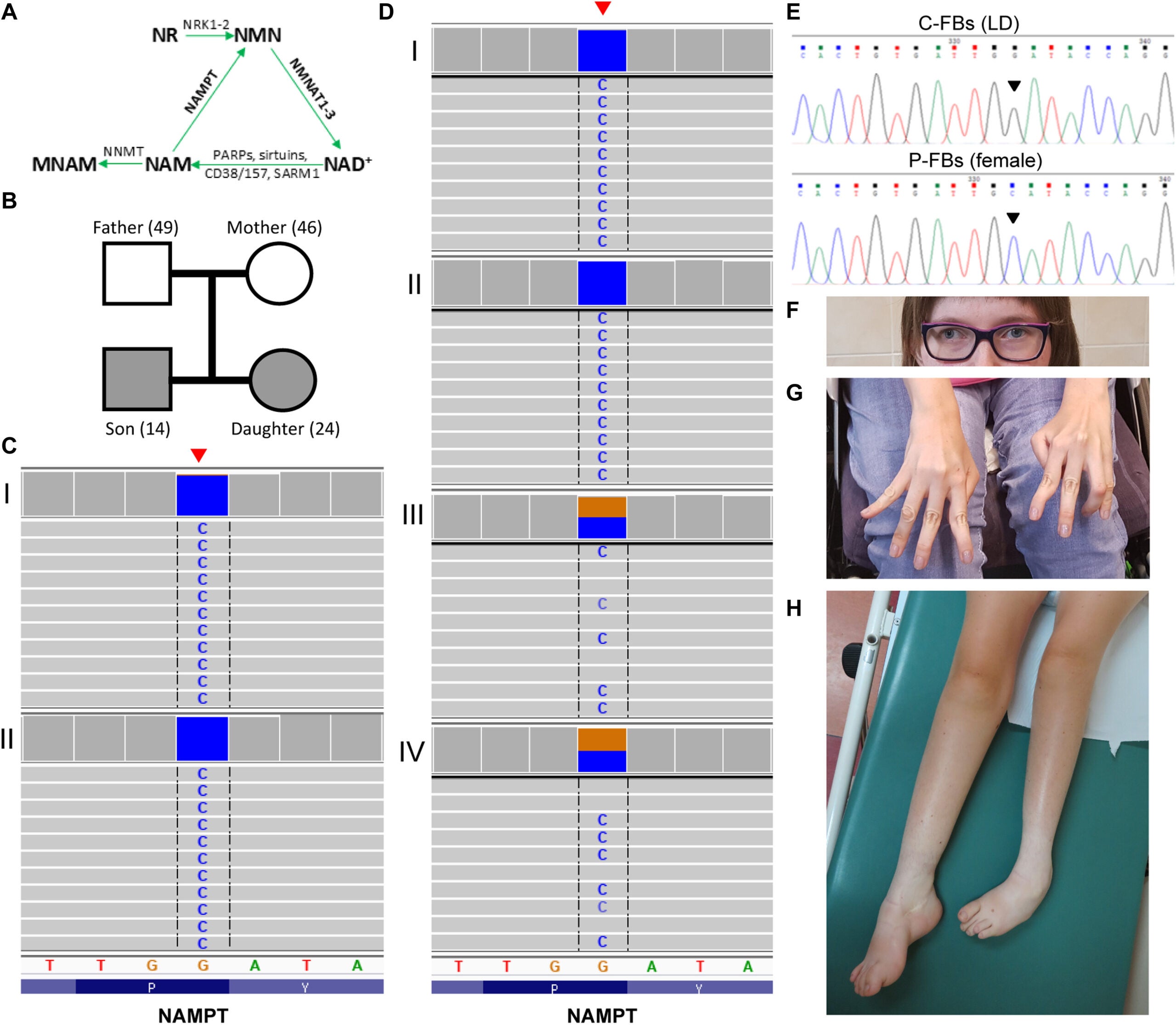 Patients with a novel sensory and motor neuropathy bear a c.472G>C (p.P158A) variant in NAMPT.