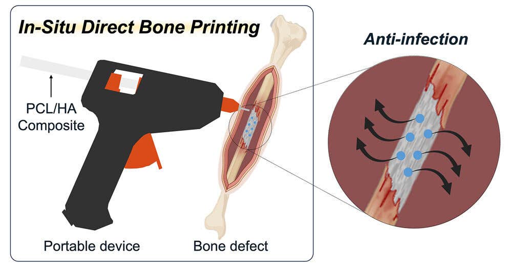 A portable device for in situ printing of bone scaffolds