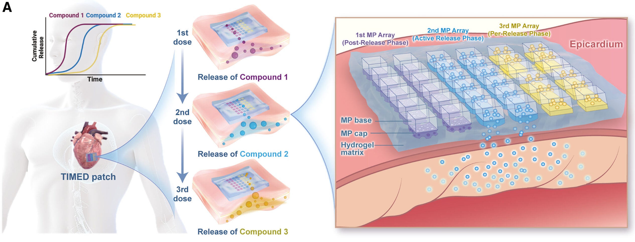 Schematic illustrating the multi-phasic therapeutic delivery profile of the TIMED system implanted on the heart, with sequential release of different compounds shown in different colors. The enlarged view illustrates the phase-specific release, where therapeutic agents are released through the particle cap into the heart muscle.
